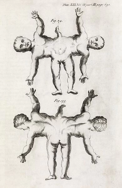 Conjoined twins, 18th century