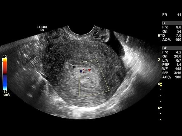Endometrial polyp, ultrasound scan C017  /  7799