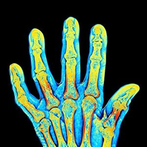 Arthritic hand bones