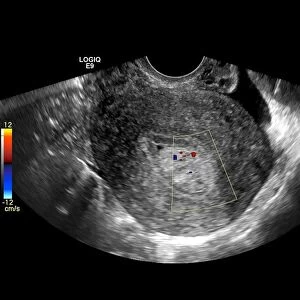 Endometrial polyp, ultrasound scan C017 / 7799