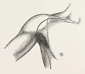 interscapulo-tholtacic amputation, medical equipment, surgical instrument, history